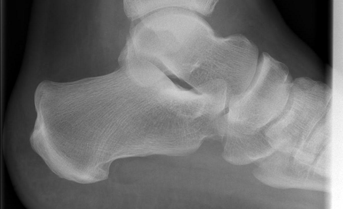 Calcaneum Normal Bohlers Angle